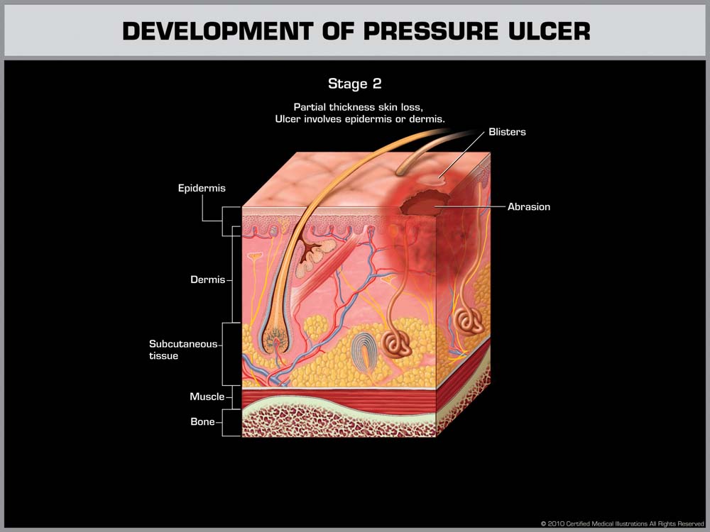 Collaborative Pressure Ulcer Prevention: An Automated Skin Damage and Pressure  Ulcer Assessment Tool for Nursing Professionals,