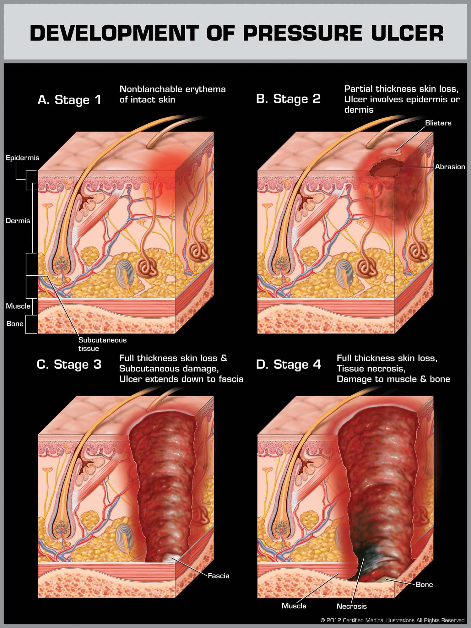 New Jersey Nursing Home Attorney - Development Of Pressure Ulcer