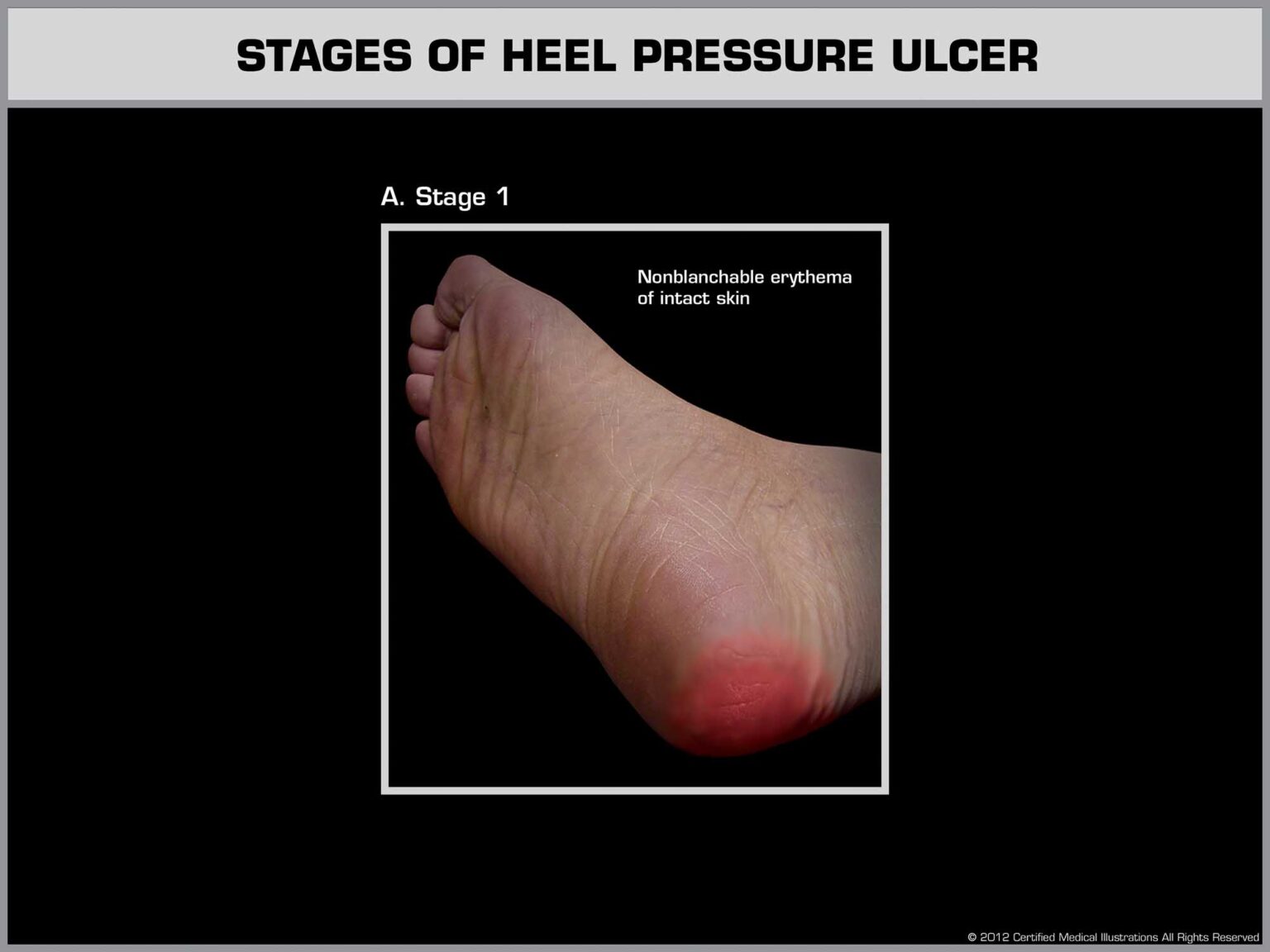 New Jersey Nursing Home Attorney Bedsores & Ulcer Injury Cherry Hill