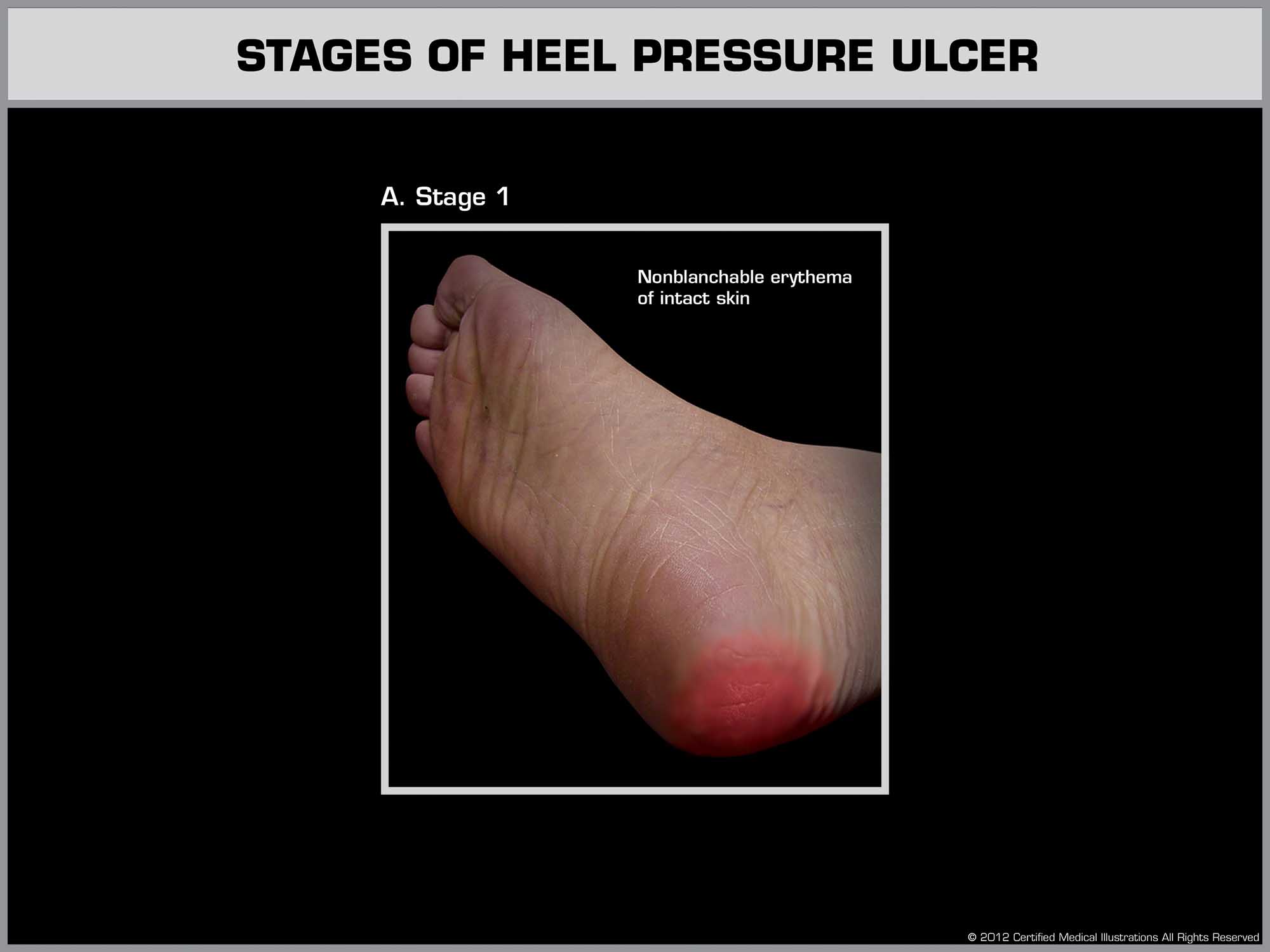 Stages of Heel Pressure Ulcer - Stage 1 Stages of Heel Pressure Ulcer - Stage 1