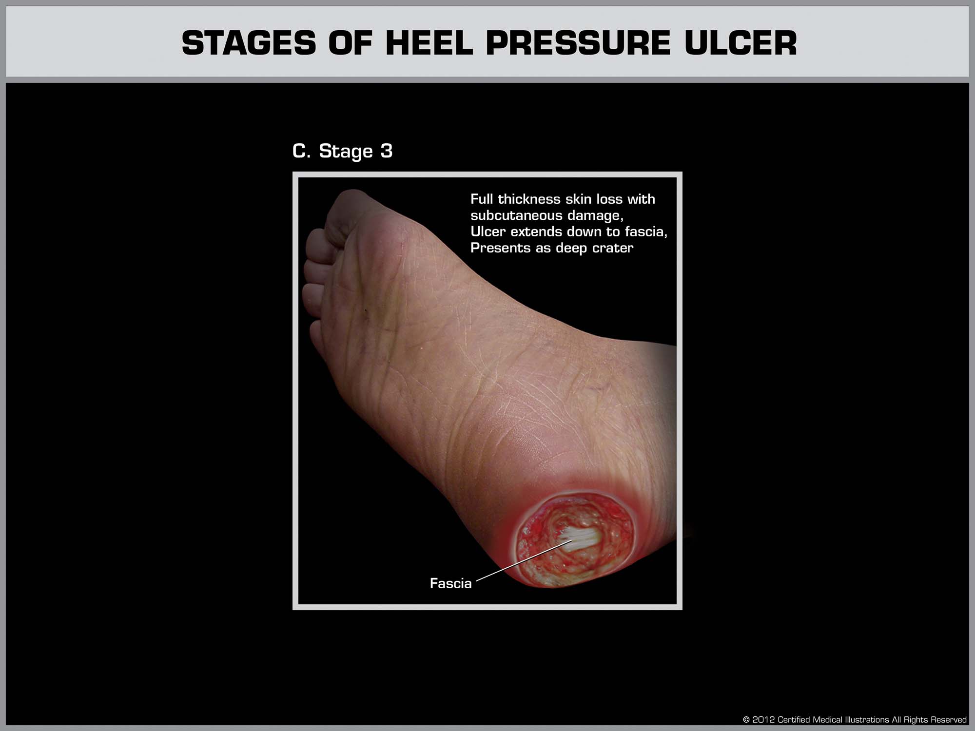 Development of a Heal Ulcer - Stage 3 - Law Office of Andrew A. Ballerini