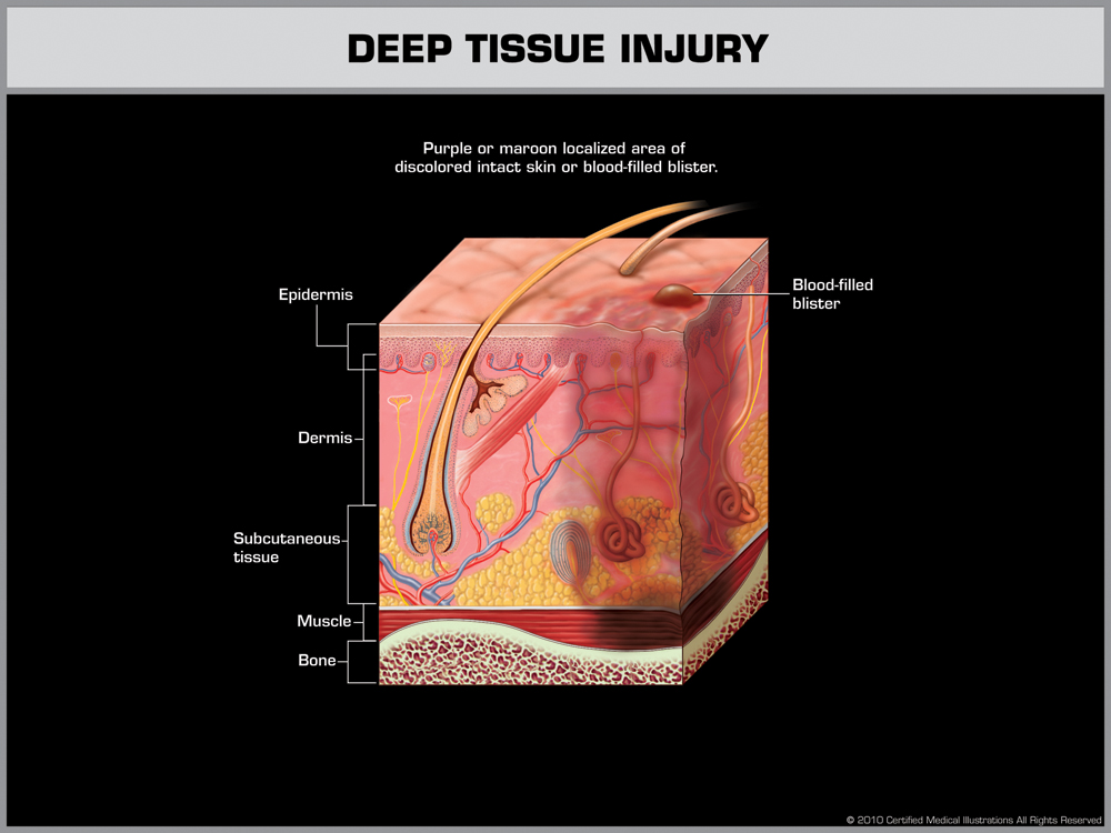 Deep Tissue Injury (DTI)