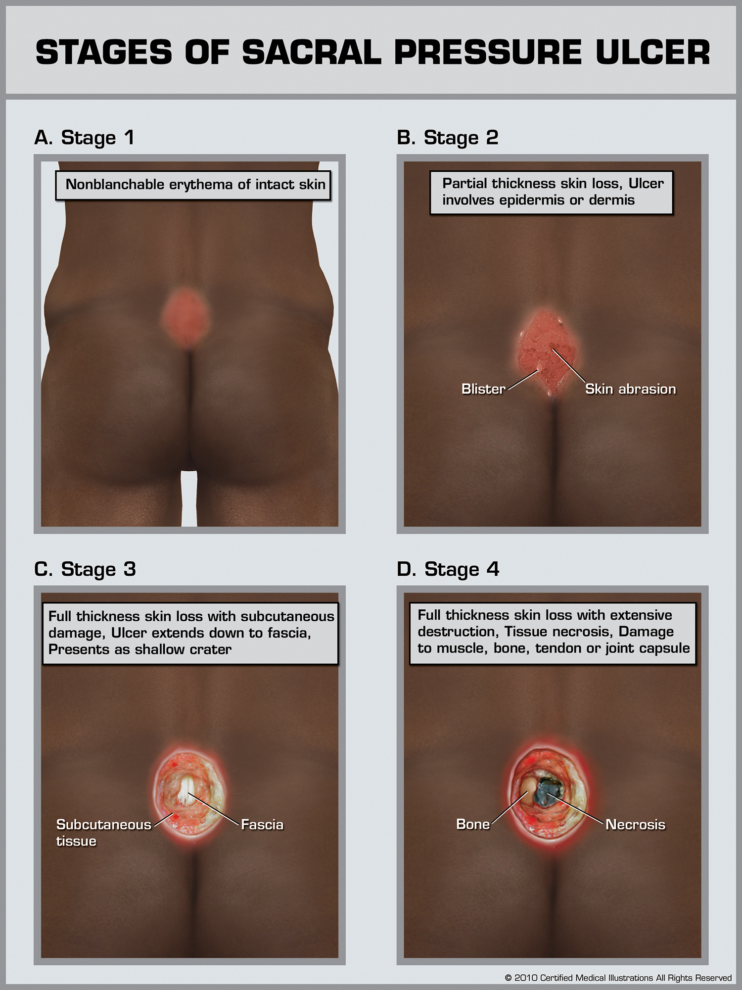 Pressure Ulcers On Lower Back
