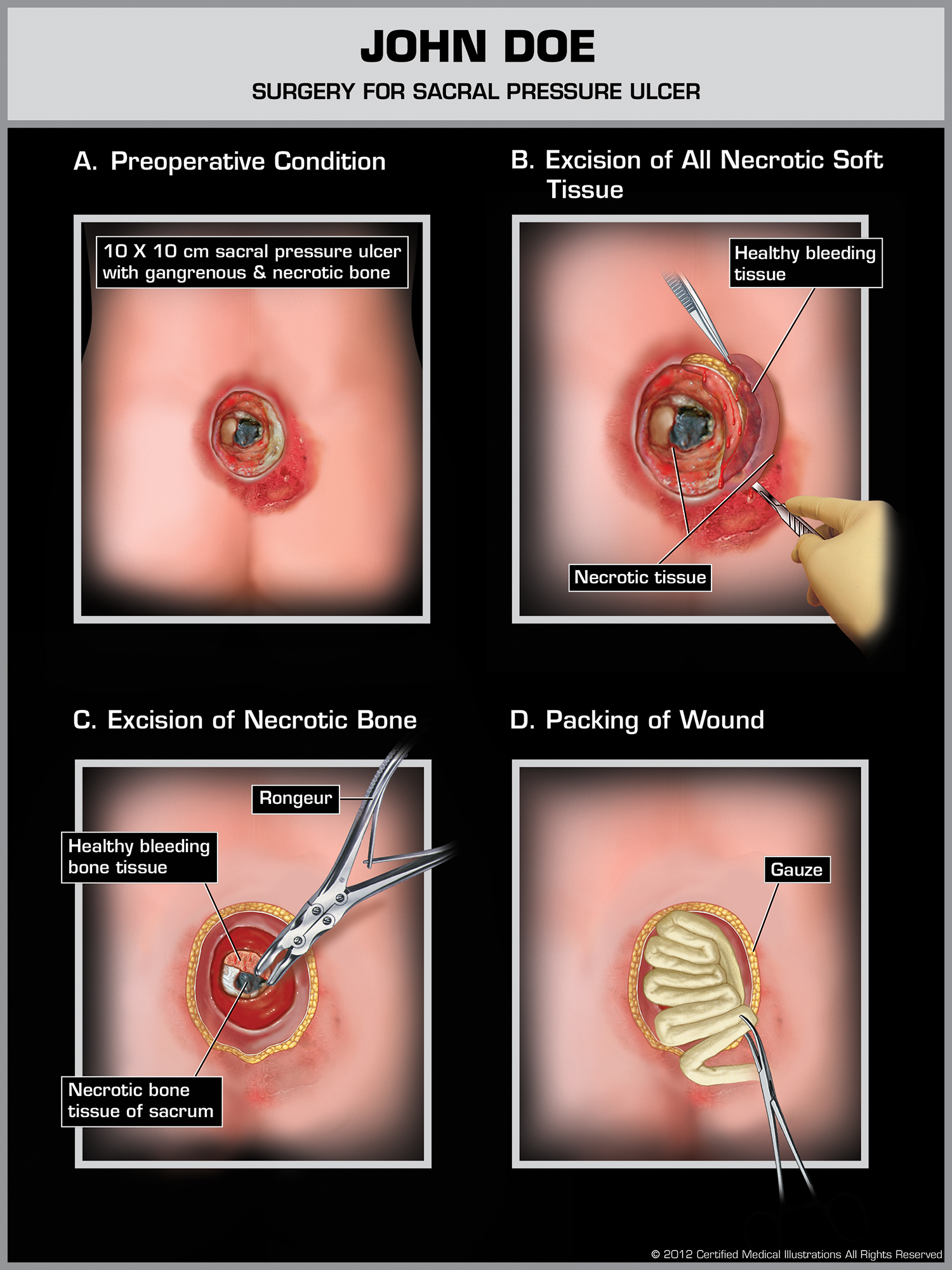 Sacral Pressure Ulcers