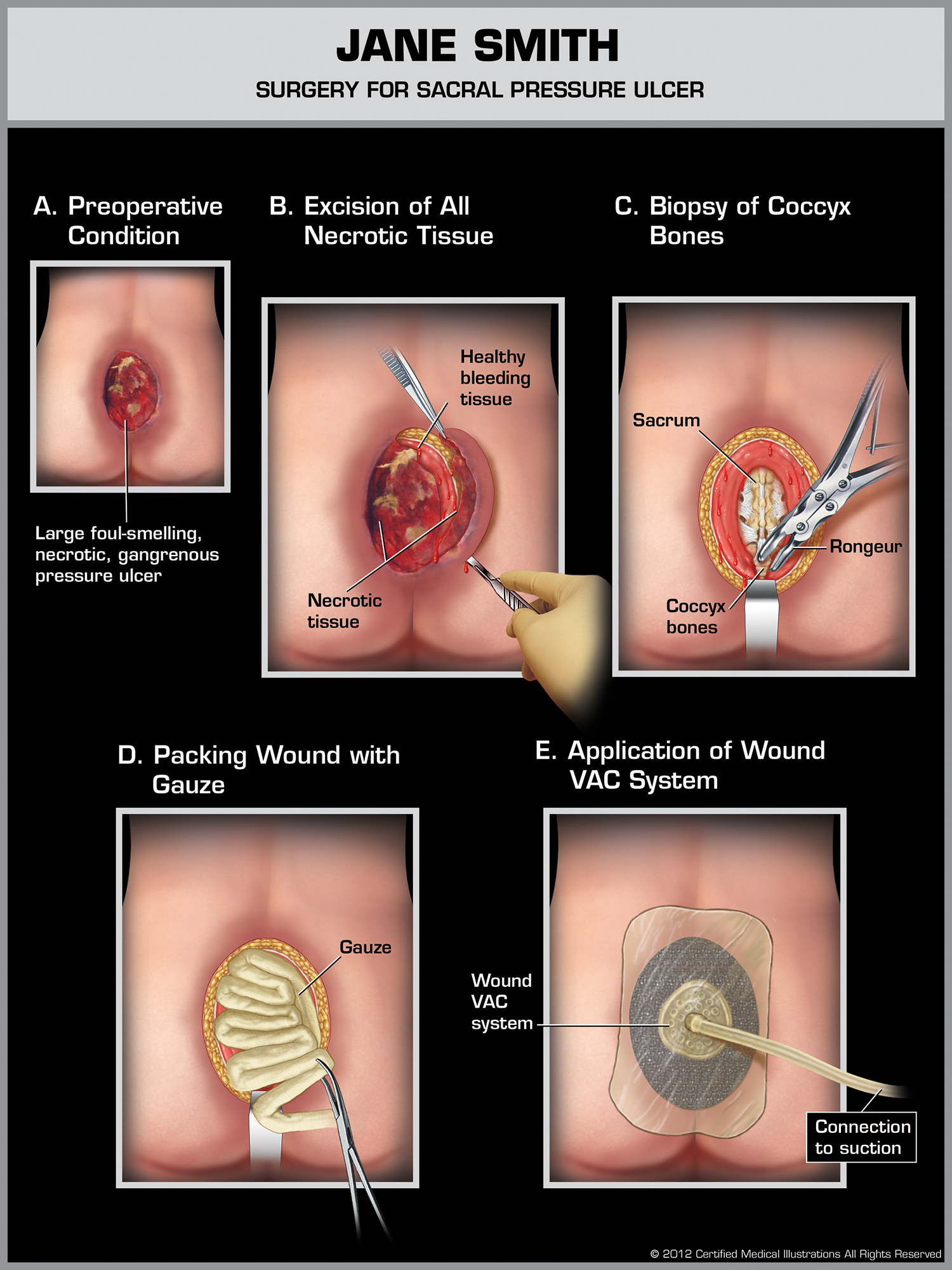 Sacral Wound Surgery