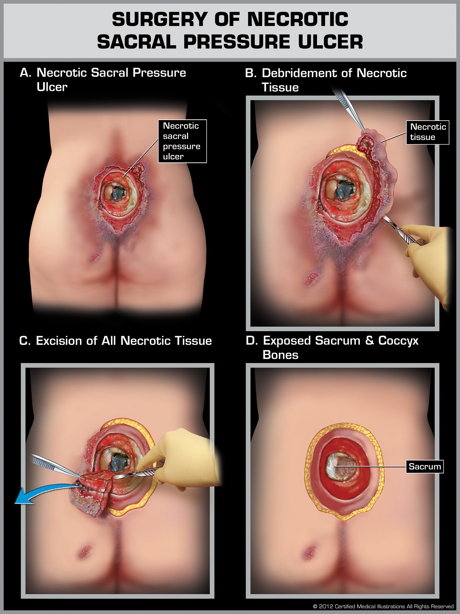 Surgery of Necrotic Sacral Pressure Ulcer