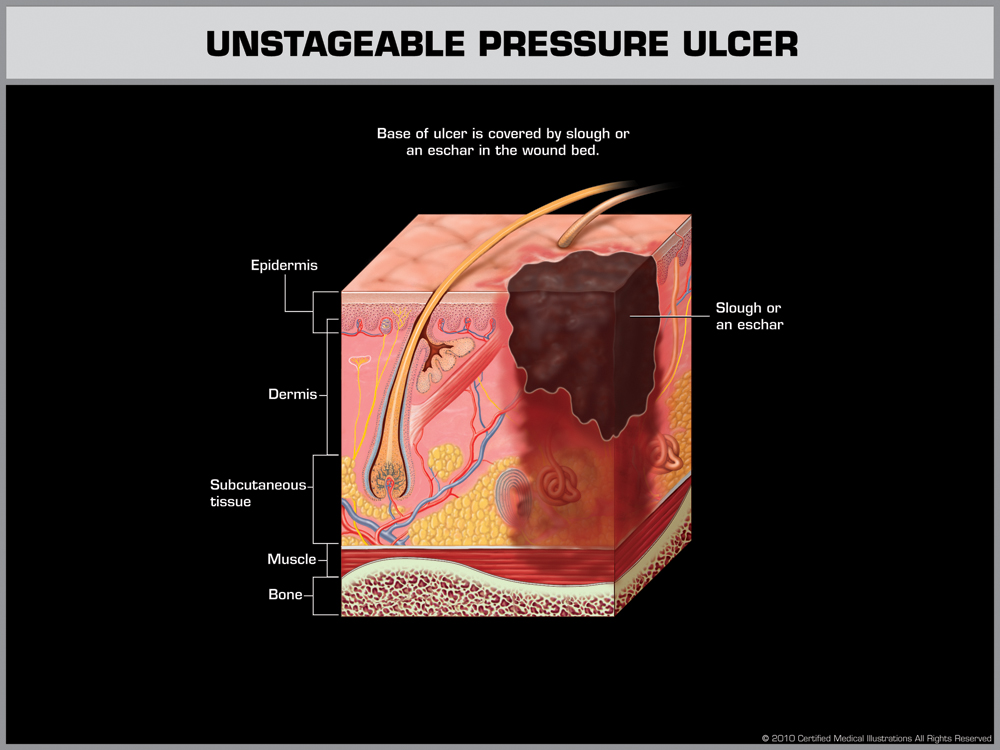 Unstageable Pressure Ulcer