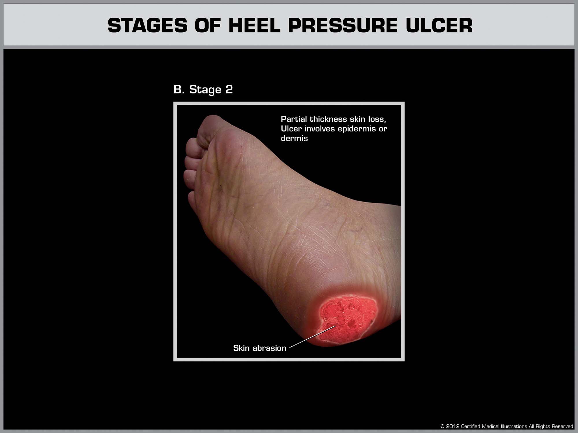 Stage 2 heel bedsore with partial thickness skin loss and visible abrasion – possible indicator of poor care in New Jersey nursing homes