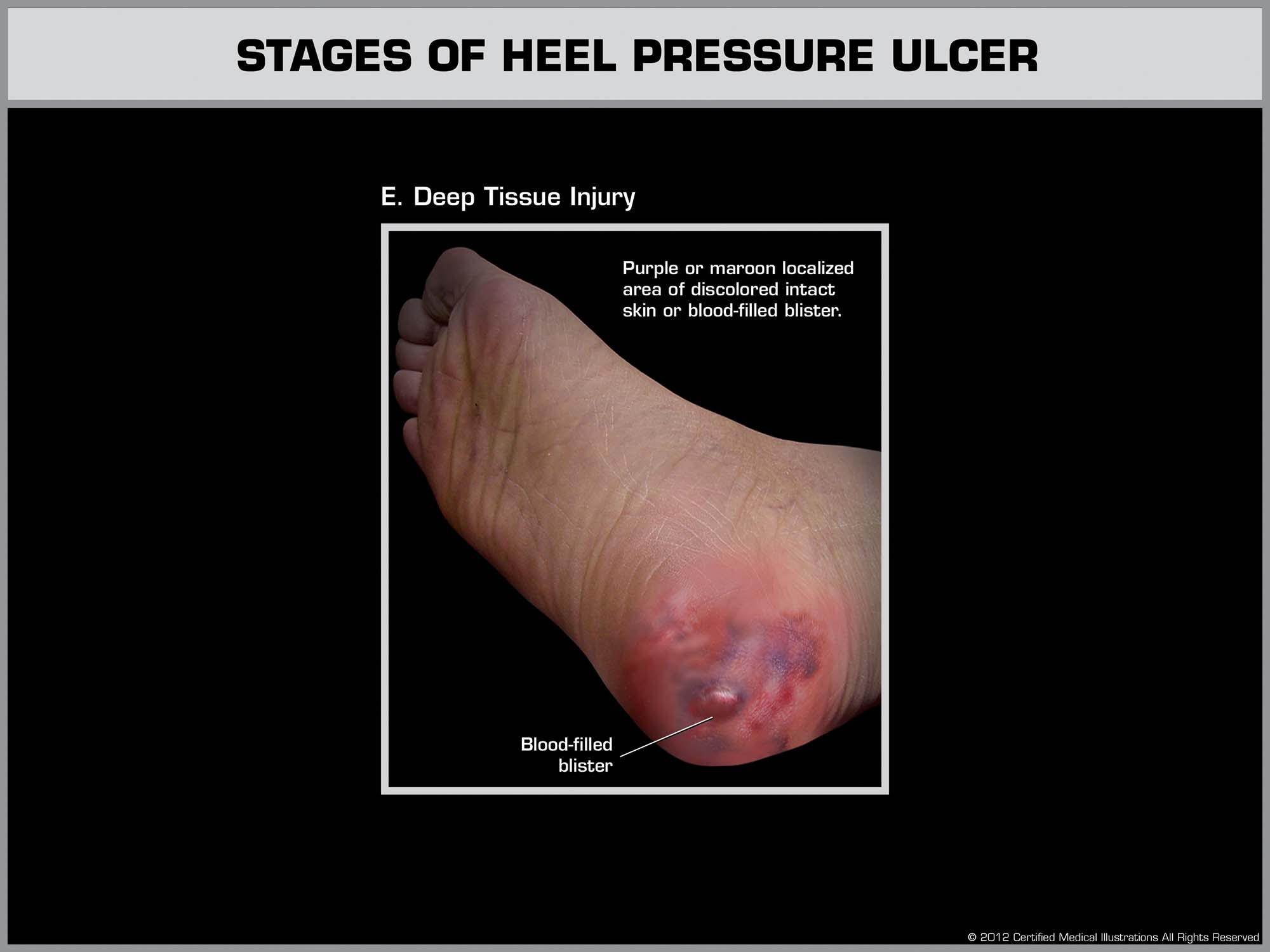 Deep tissue injury on heel with maroon discoloration and blood-filled blister – potential early-stage bedsore hidden under skin