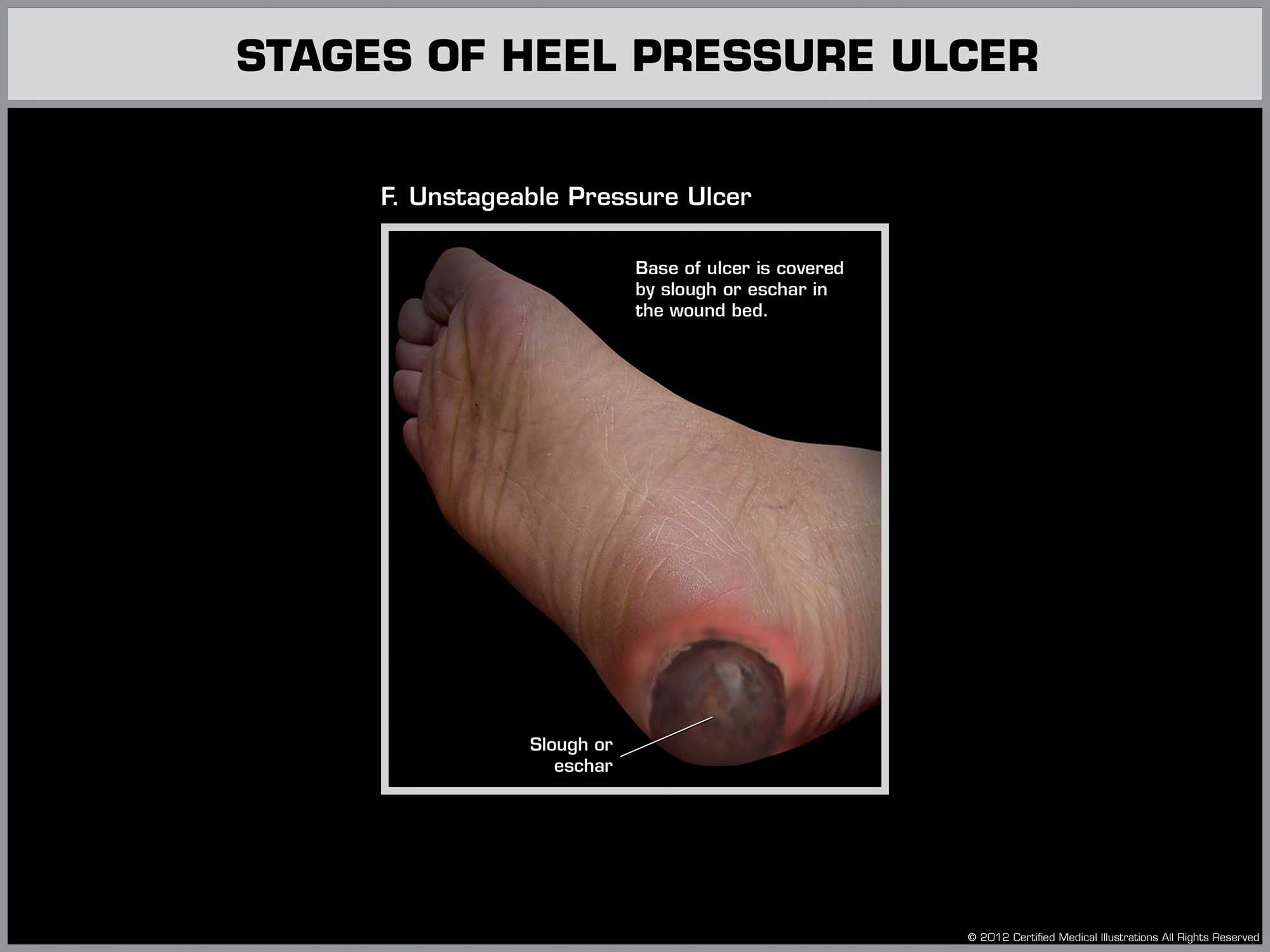 Unstageable heel pressure ulcer covered by slough or eschar – wound severity obscured, often requiring surgical evaluation
